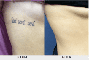 before and after Picosure laser tattoo removal