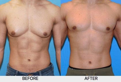 gyno surgery bodybuilder before after chicago