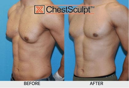 bodybuilder gynecomastia before and after photo