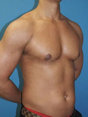 Xsculpt, Gynecomastia Grade II <br>Case# 12