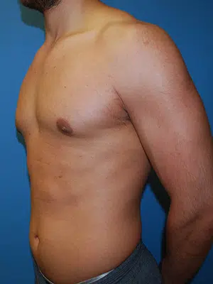 Xsculpt, Gynecomastia Grade I <br>Case# 330