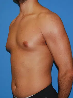 Xsculpt, Gynecomastia Grade I <br>Case# 330