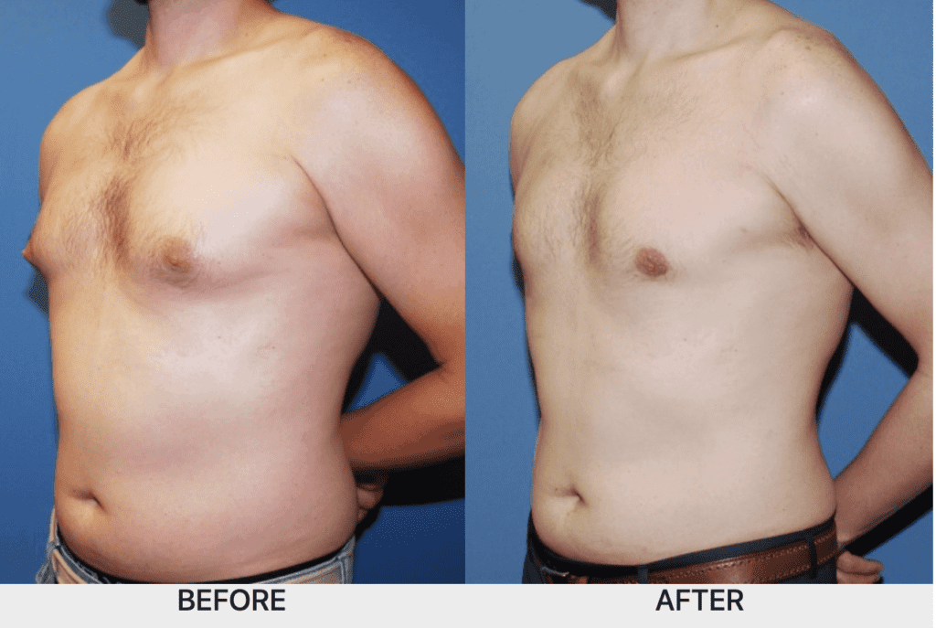 Best Gynecomastia Surgeons for puffy nipples in men