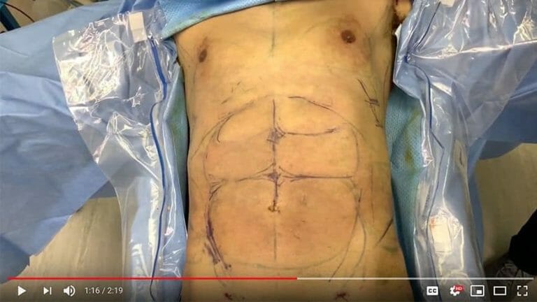 Gynecomastia Surgery & HD Ab Sculpting Results Chicago 9 Grade 2 Gynecomastia Surgery & High Definition Abdominal Sculpting Results in Chicago