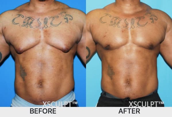 gyno surgery bodybuilder before and after chicago xsculpt