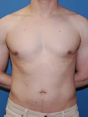 Xsculpt, Gynecomastia Grade I <br>Case# 424