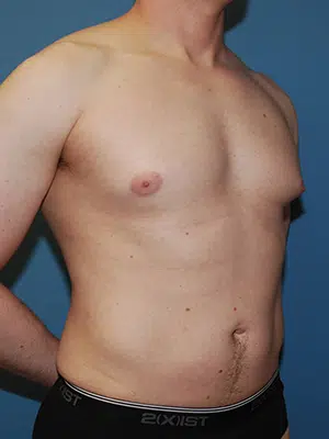 Xsculpt, Gynecomastia Grade I <br>Case# 424