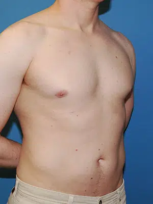 Xsculpt, Gynecomastia Grade I <br>Case# 424