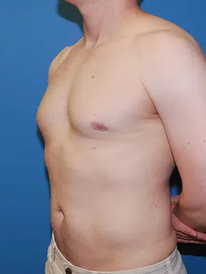 Xsculpt, Gynecomastia Grade I <br>Case# 424