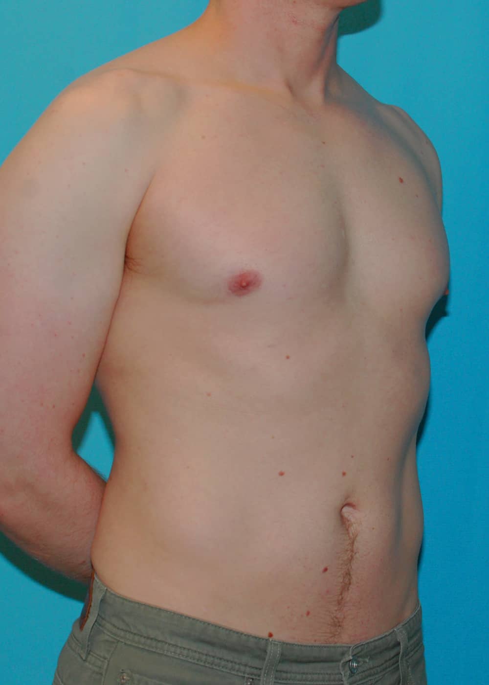 Xsculpt, Gynecomastia 44