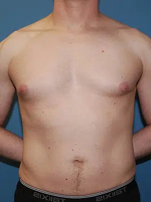 Xsculpt, Gynecomastia Grade I <br>Case# 424