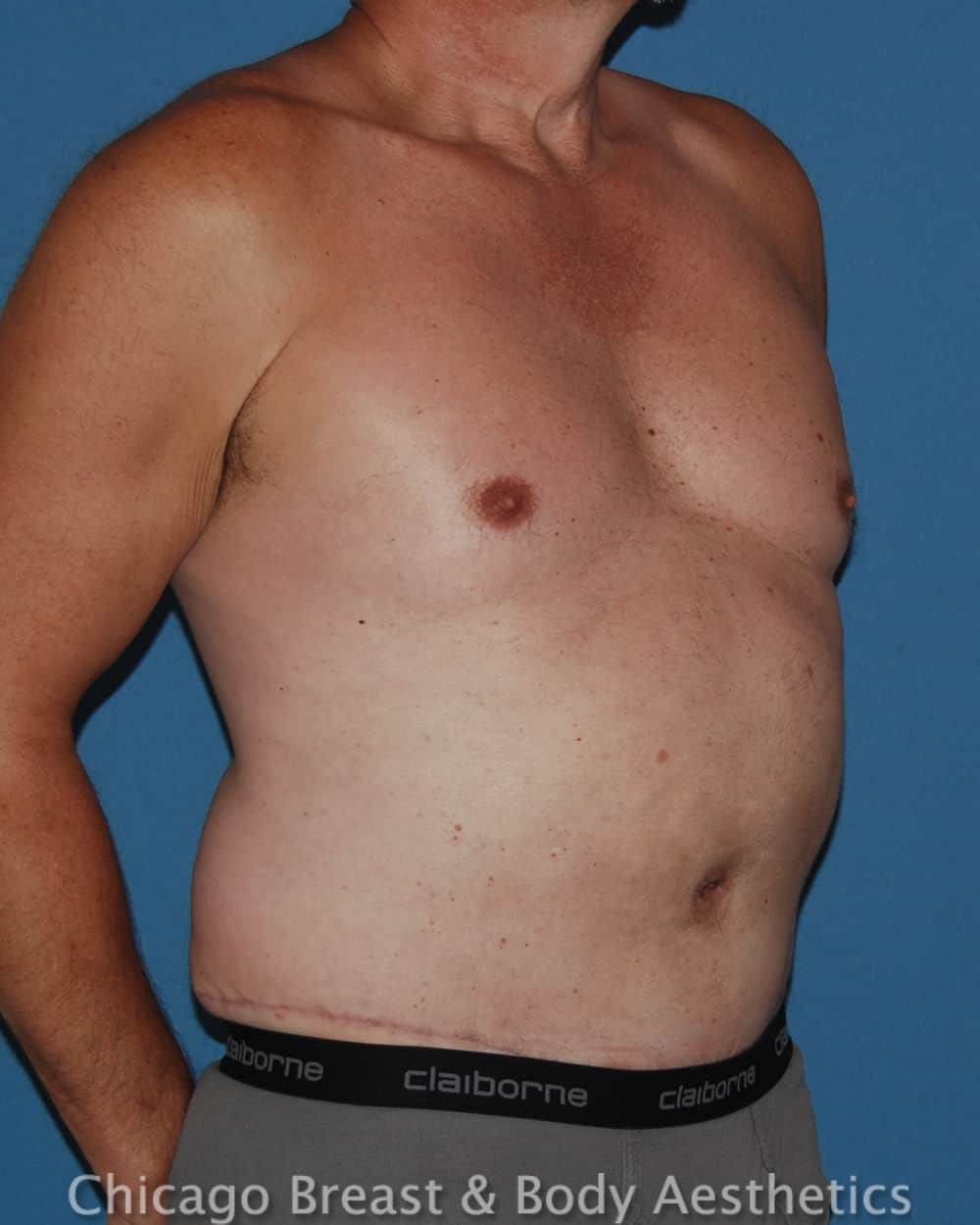 Xsculpt, TotalSculpt™ | Male Tummy Tuck Case#239