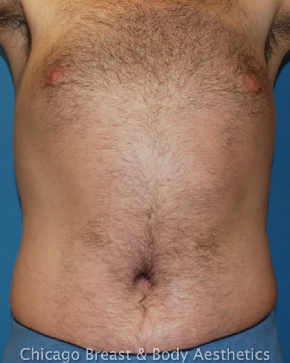 Xsculpt TotalSculpt™ | Male Tummy Tuck Case#344