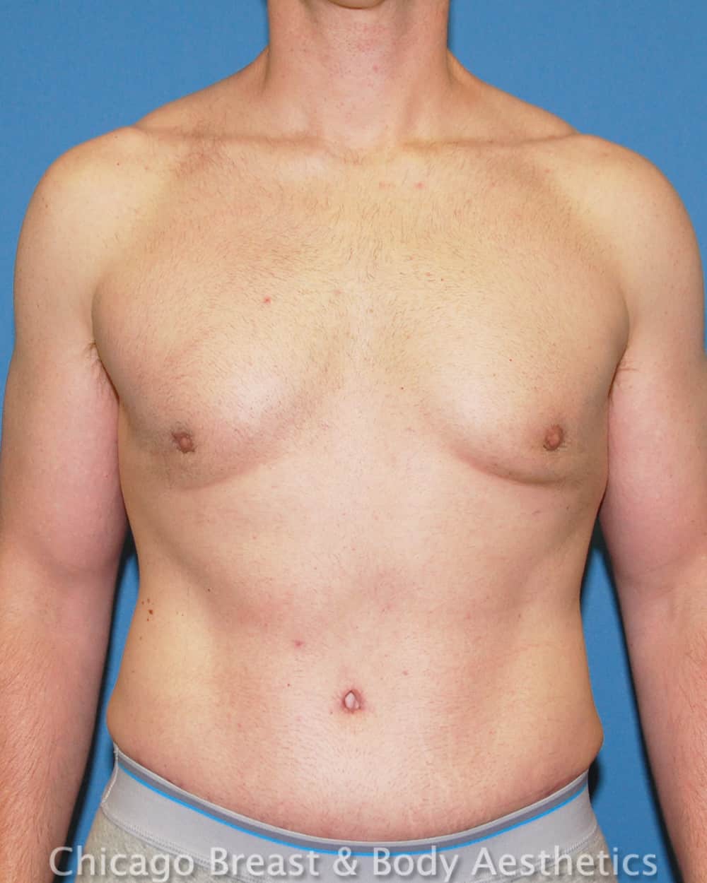 Xsculpt, TotalSculpt™ | Male Tummy Tuck Case# 387