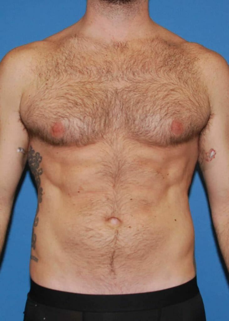 abdominal etching before and after photo at xsculpt chicago