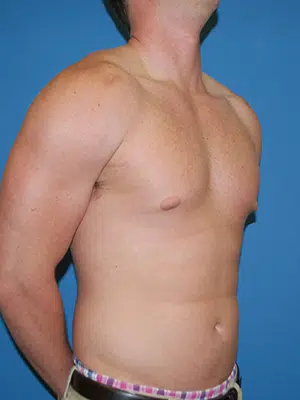 Xsculpt, Gynecomastia Grade I <br>Case# 26