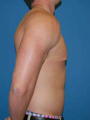 Xsculpt, Gynecomastia Grade I <br>Case# 26