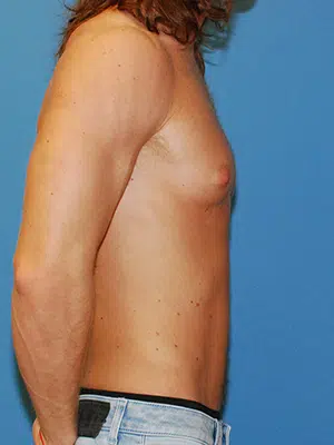 Xsculpt, Gynecomastia Grade I <br>Case#  36369