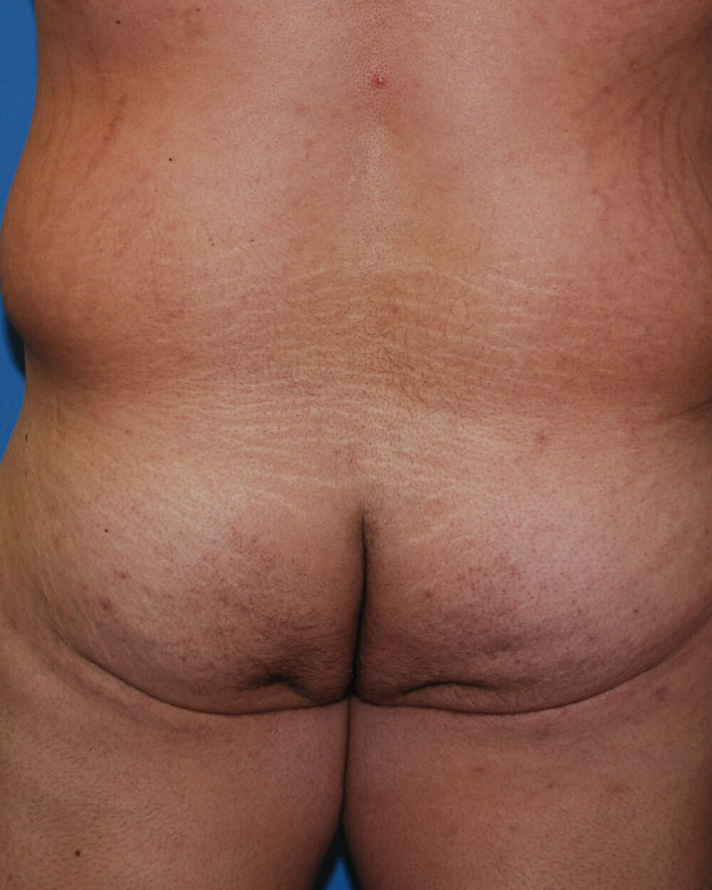 Xsculpt, Male fat transfer to buttocks