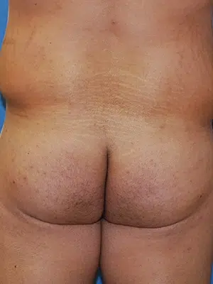 Xsculpt, Male Brazilian Butt Lift Case# 36286-2