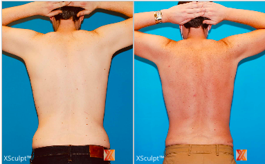 Fat Removal Surgery For a Slim Body 2 lipo360 before after male at xsculpt