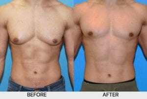 before and after ChestSculpt™ - XSculpt Surgical Procedures