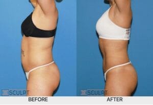 before and after SculpSure’s non-invasive fat reduction