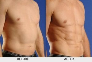 AbSculpt™ before and after - XSculpt Surgical Procedures