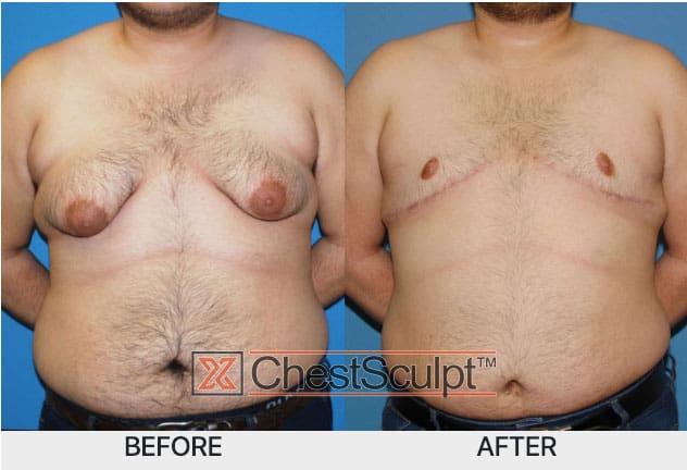 grade 4 gynecomastia before and after photo - xsculpt