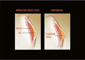 Normal male breast and Gynecomastia