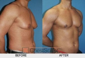 Gynecomastia Surgery before and after - medical procedures