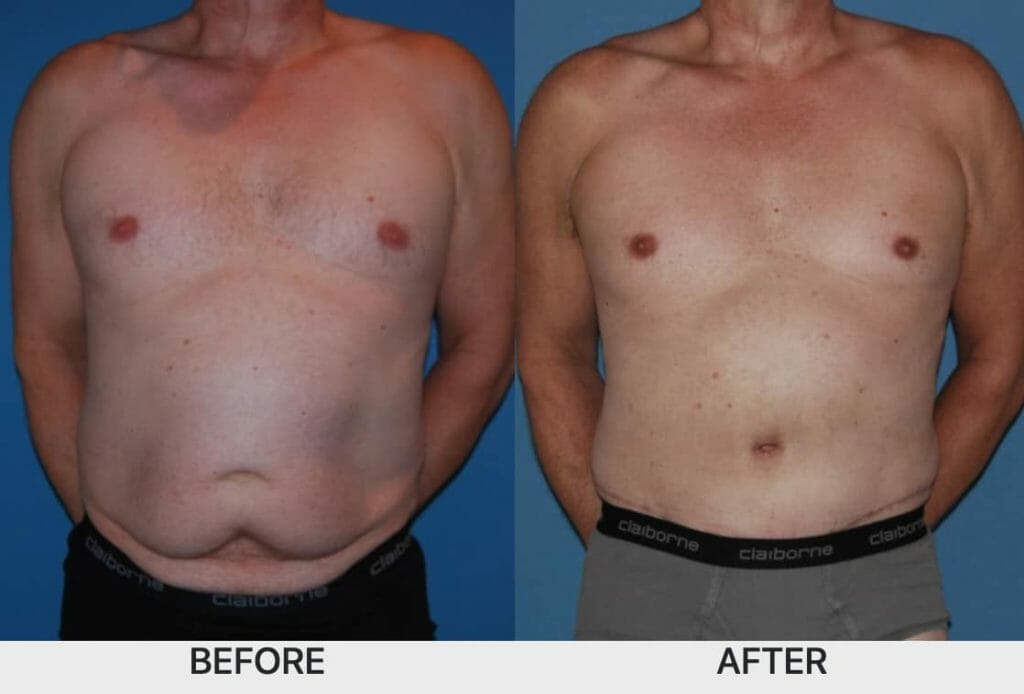 Male tummy tuck recovery