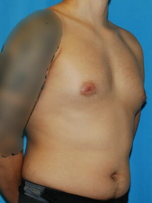 Xsculpt Gynecomastia ChestSculpt | SmartLipo Case# 229