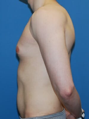 Xsculpt Gynecomastia ChestSculpt Case# 222
