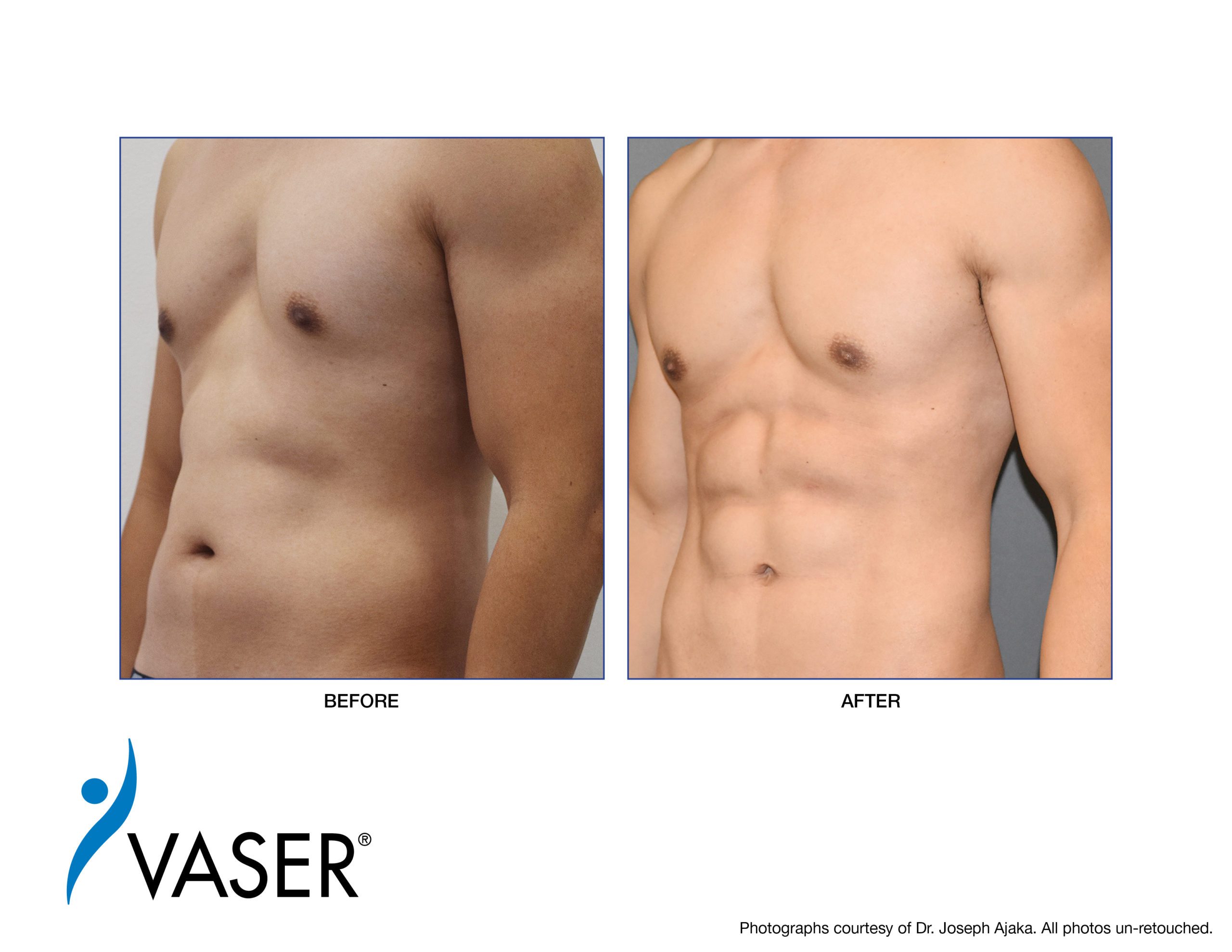 VASER-Ajaka-Before-After02