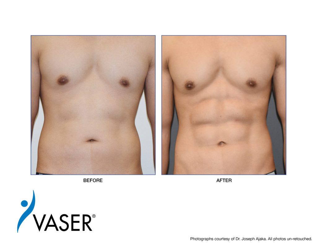 before and after VASER Liposuction on a male ChestSculpt patient