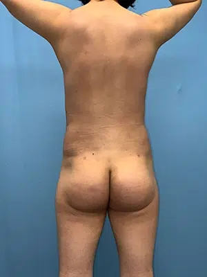 Xsculpt, Male Brazilian Butt Lift Case# 929