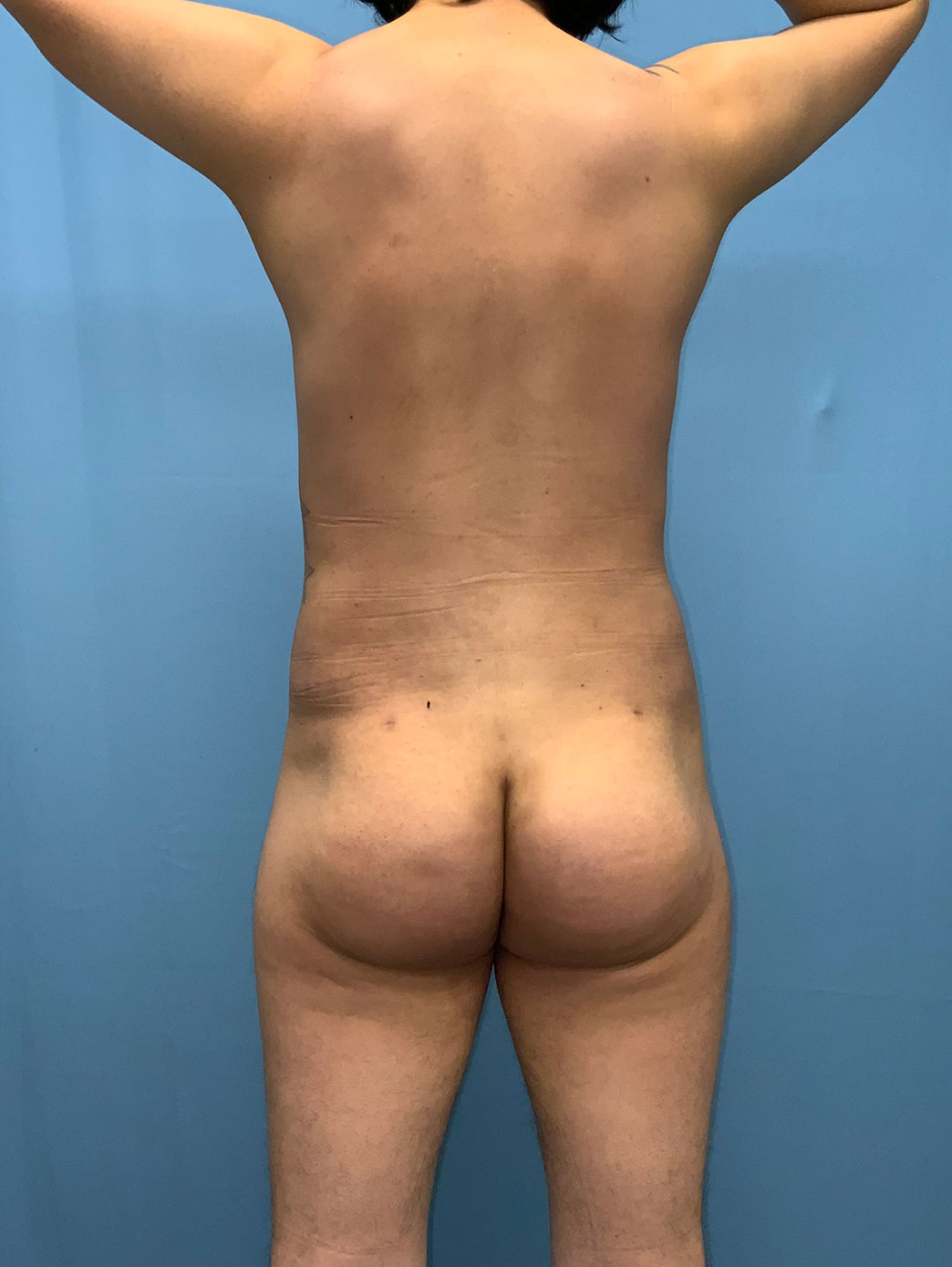 Xsculpt Male Brazilian Butt Lift Case# 929