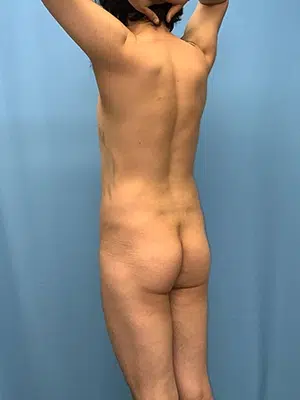 Xsculpt, Male Brazilian Butt Lift Case# 929