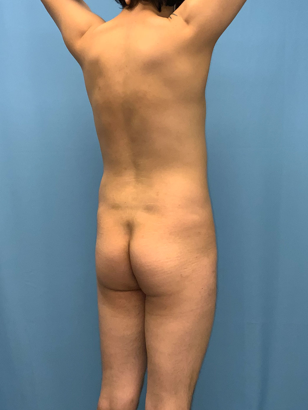 Xsculpt Male Brazilian Butt Lift Case# 929