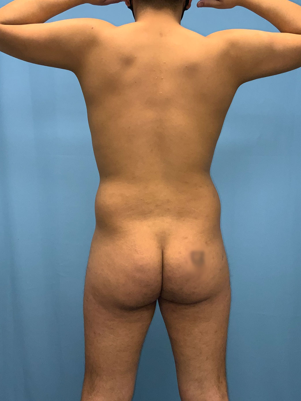 Xsculpt Male Brazilian Butt Lift Case# 23