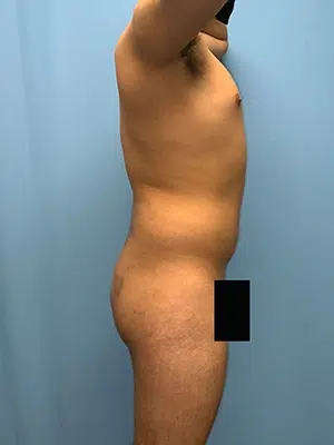Xsculpt, Male Brazilian Butt Lift Case# 23