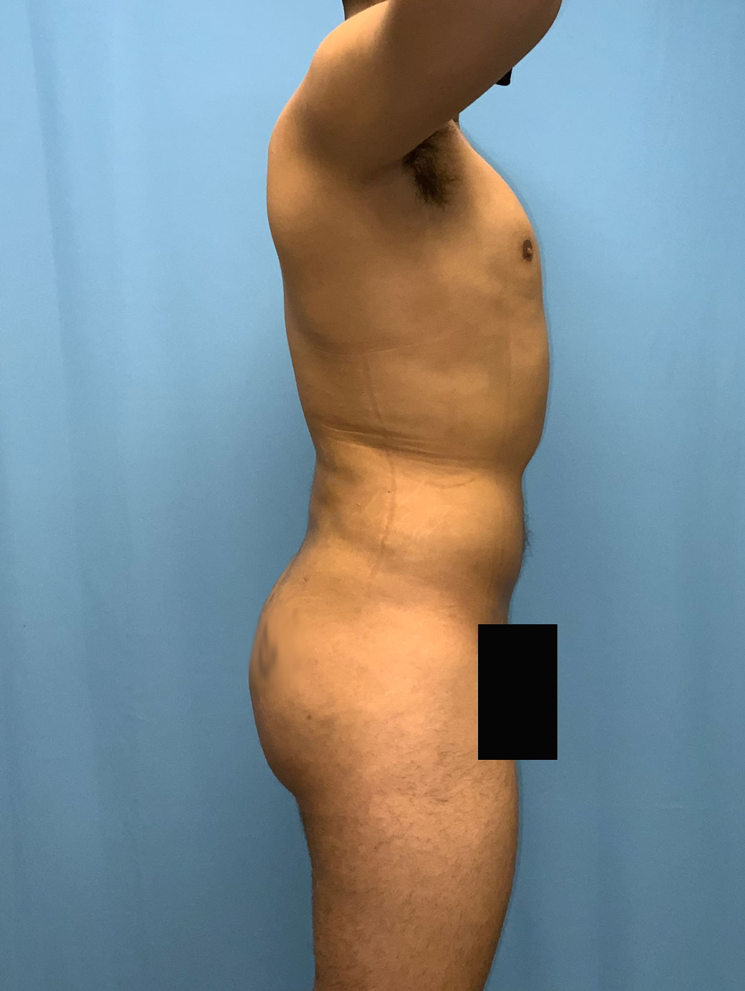Xsculpt, Male Brazilian Butt Lift Case# 23