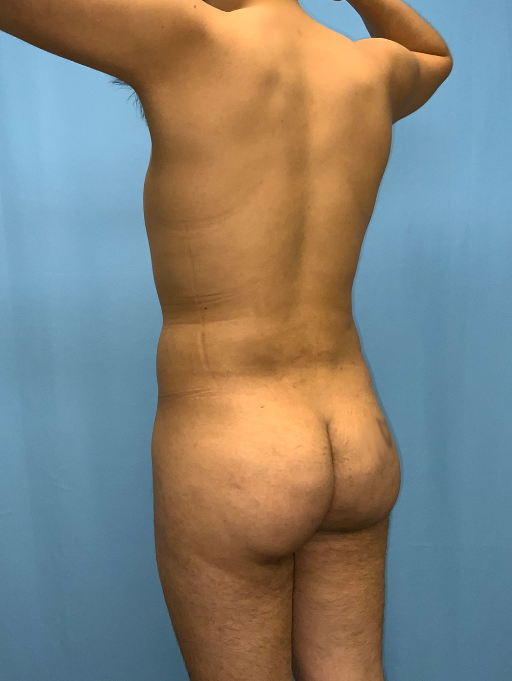 Xsculpt Male Brazilian Butt Lift Case# 23