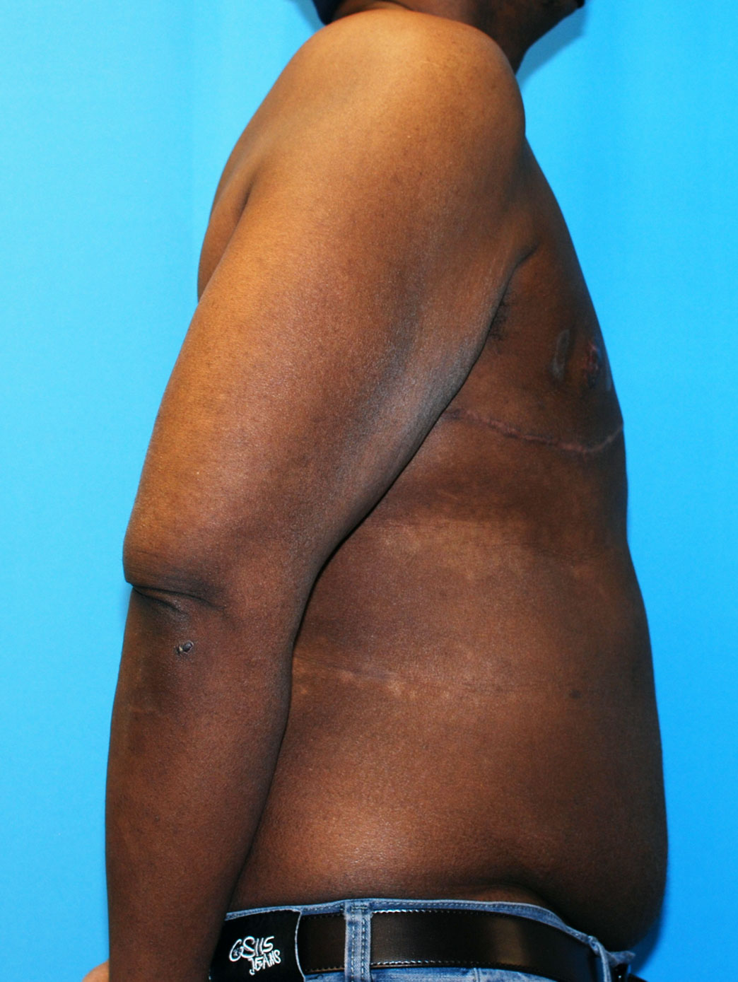 Xsculpt, Mastectomy | Gynecomastia Case #698
