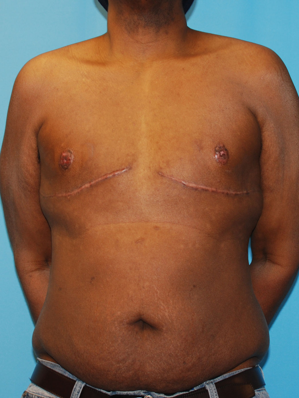 Xsculpt Mastectomy | Gynecomastia Case #698