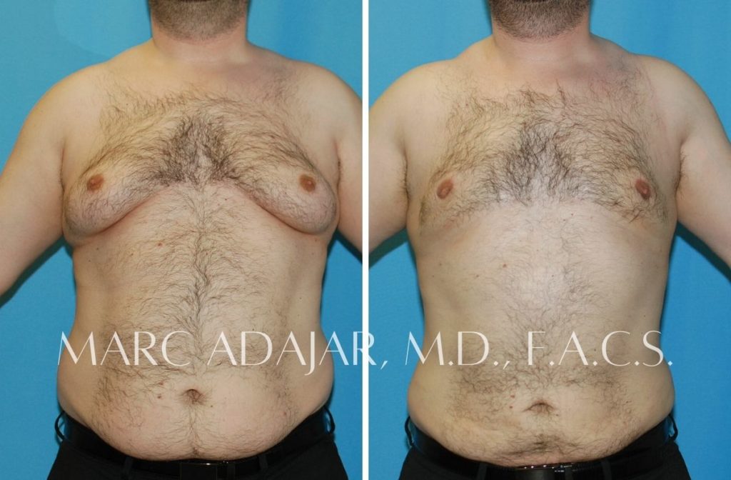 mastectomy near me - Fat Nipples In Men