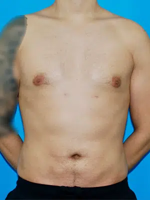 Xsculpt, Gynecomastia Grade I <br>Case#  121