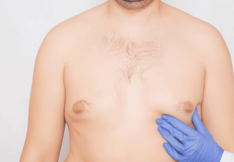 Non-Surgical Gynecomastia Treatments 1 gynecomastia treatments available today - pseudogynecomastia surgery