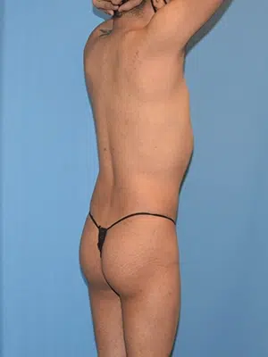 Xsculpt, Male Brazilian Butt Lift Case# 252